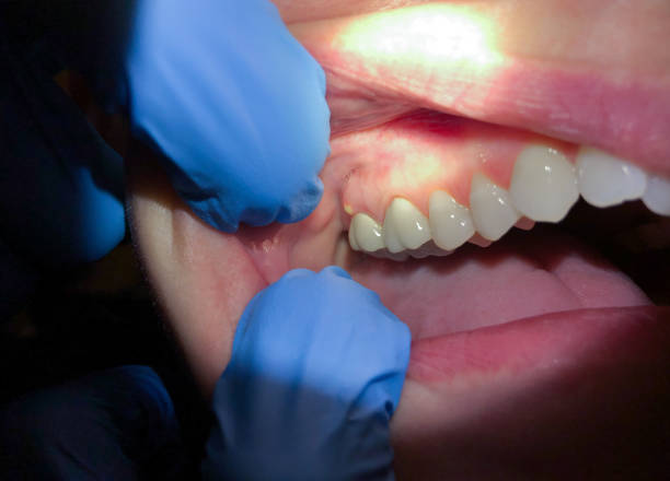 Best Emergency Dental Care for Abscessed Tooth in Lebanon, PA